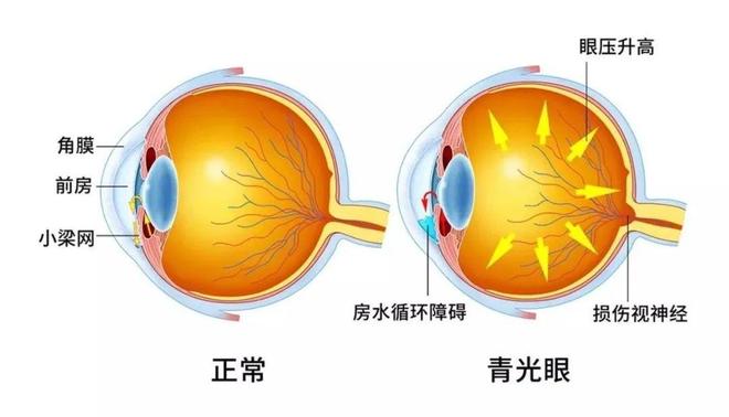 🌟开角型青光眼最新治疗方法概览✨